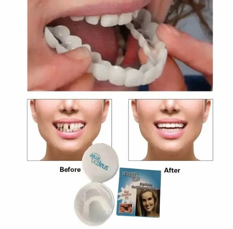 Snap-On Smile Veneers (Upper & Lower): Instant Cosmetic Teeth Braces for Natural White Look & Gap Correction