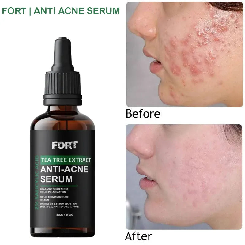 FORT Salicylic Acid Serum – Anti-Acne Face Serum & Dark Spot Correcting Serum for Glowing Skin | Acne Skin Care Products 30ml